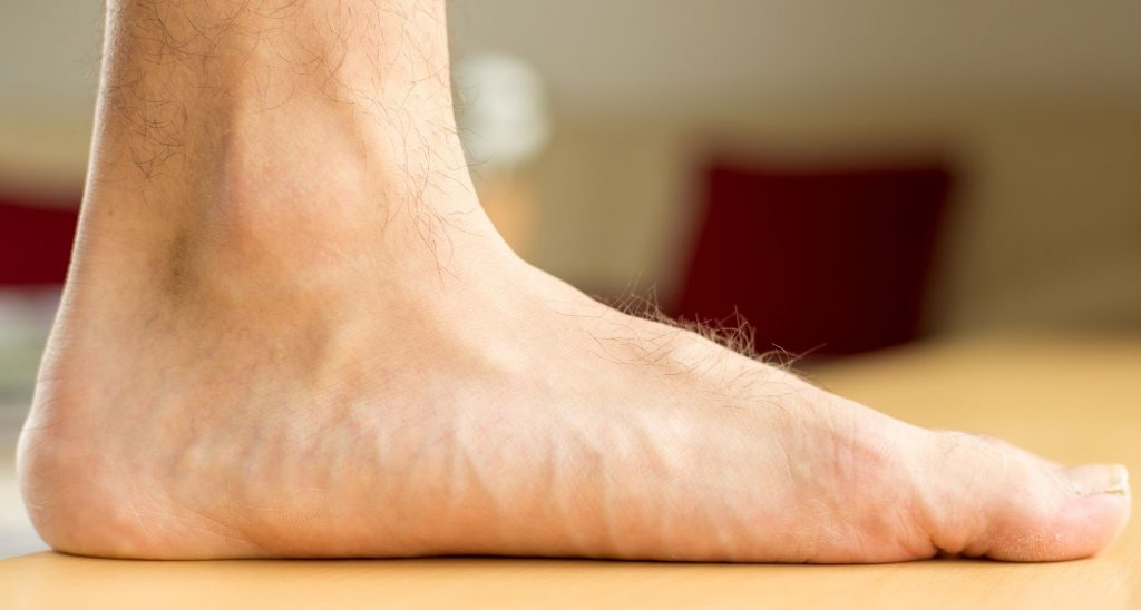 Telapak kaki datar atau flat foot adalah