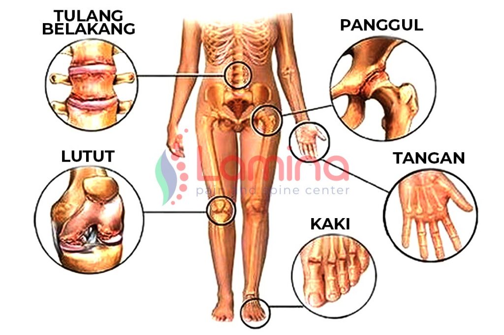 Penyebab nyeri sendi