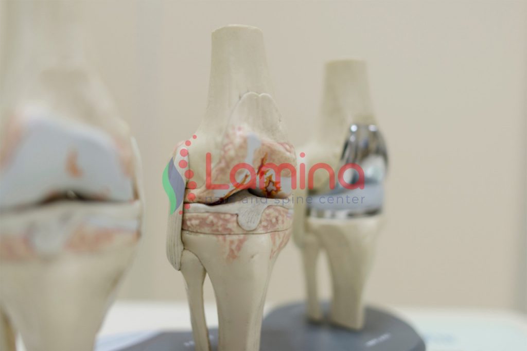 obat pengapuran lutut