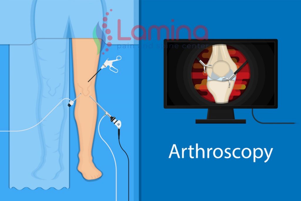 artroskopi lutut adalah