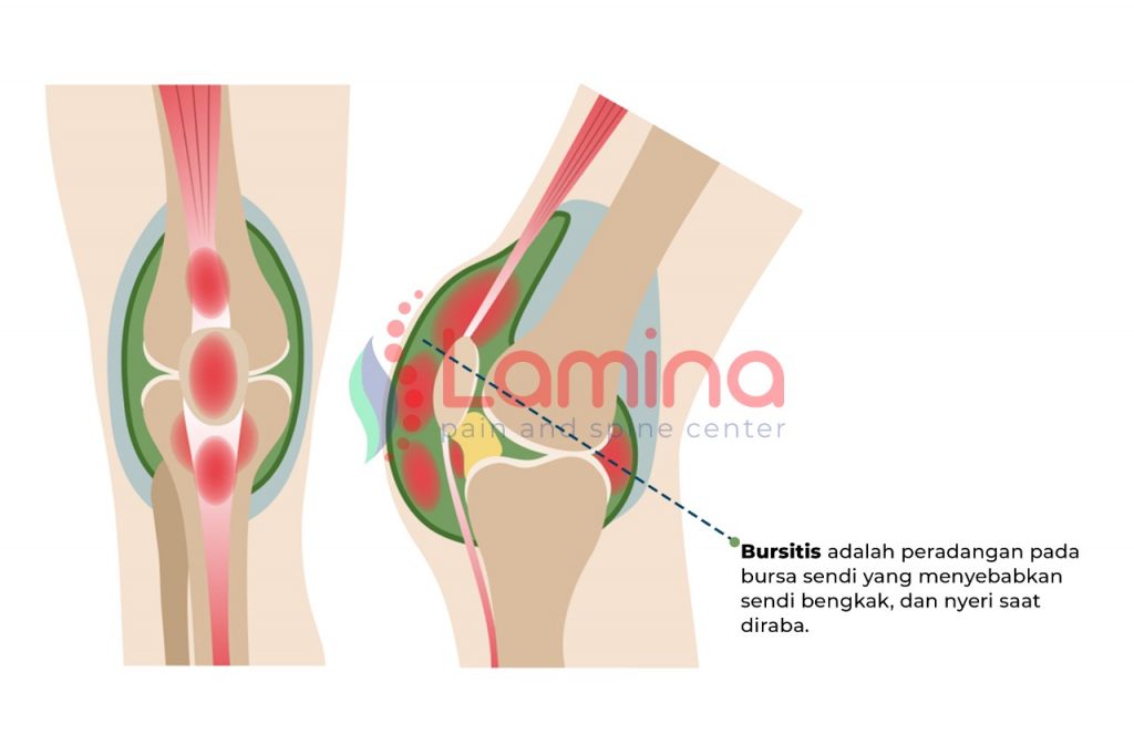 nyeri lutut akibat bursitis