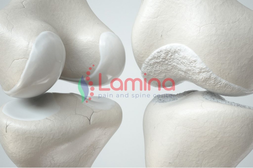 Pengobatan osteoartritis pengapuran lutut