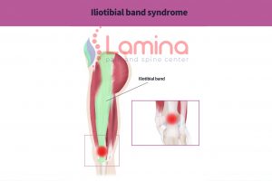 Iliotibial band syndrome