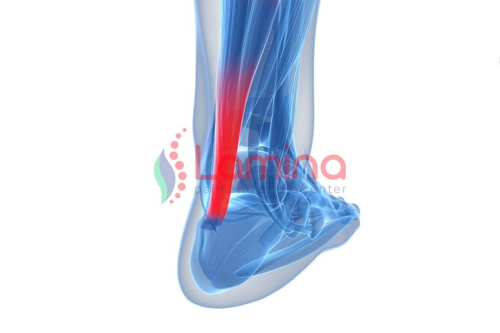 tendinitis Achilles