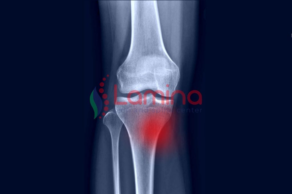 pes anserinus bursitis penyebab lutut nyeri bengkak