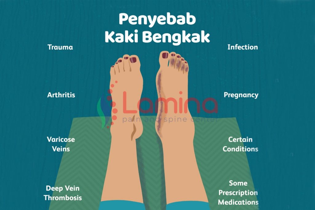 kaki bengkak penyebabnya apa