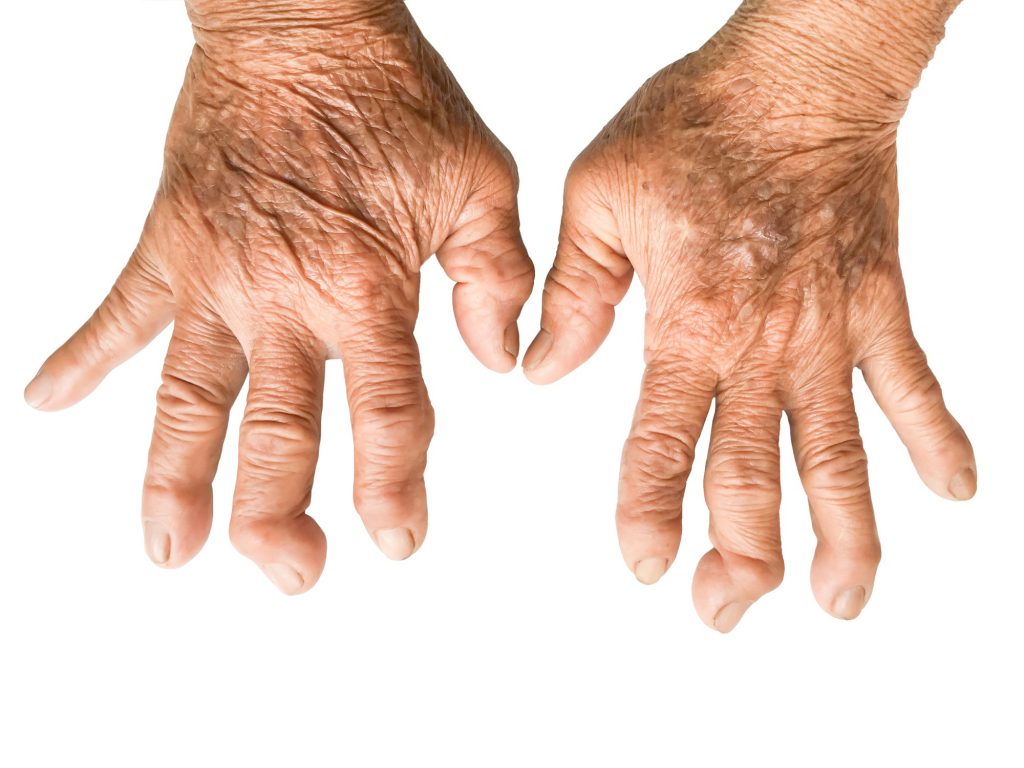 rheumatoid arthritis adalah