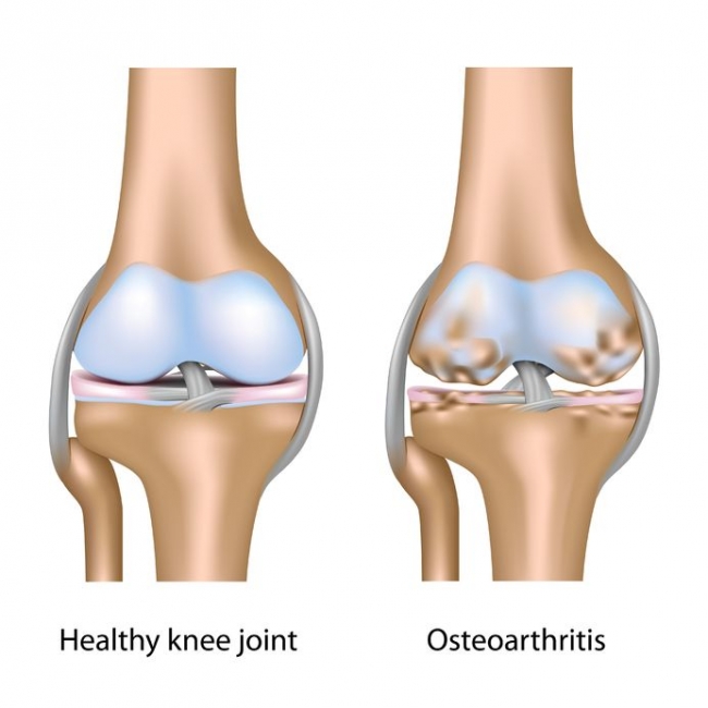 Gejala Osteoarthritis pada lutut