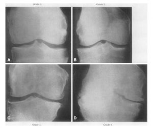 osteoarthritis genu