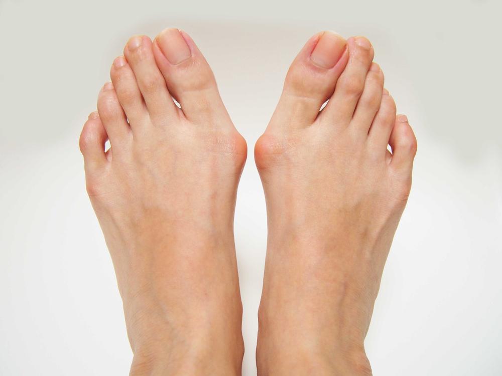 kelainan kaki bunion