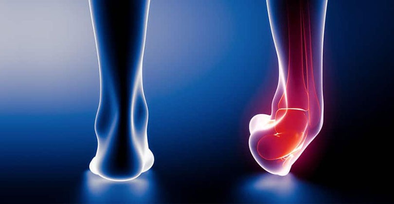 pergelangan-kaki-terkilir