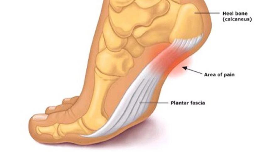 plantar fasciitis-