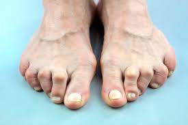 kelianan bentuk kaki