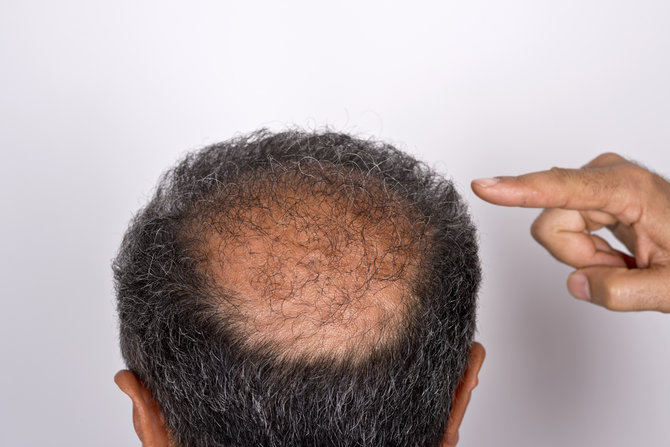 alopesia androgenetik