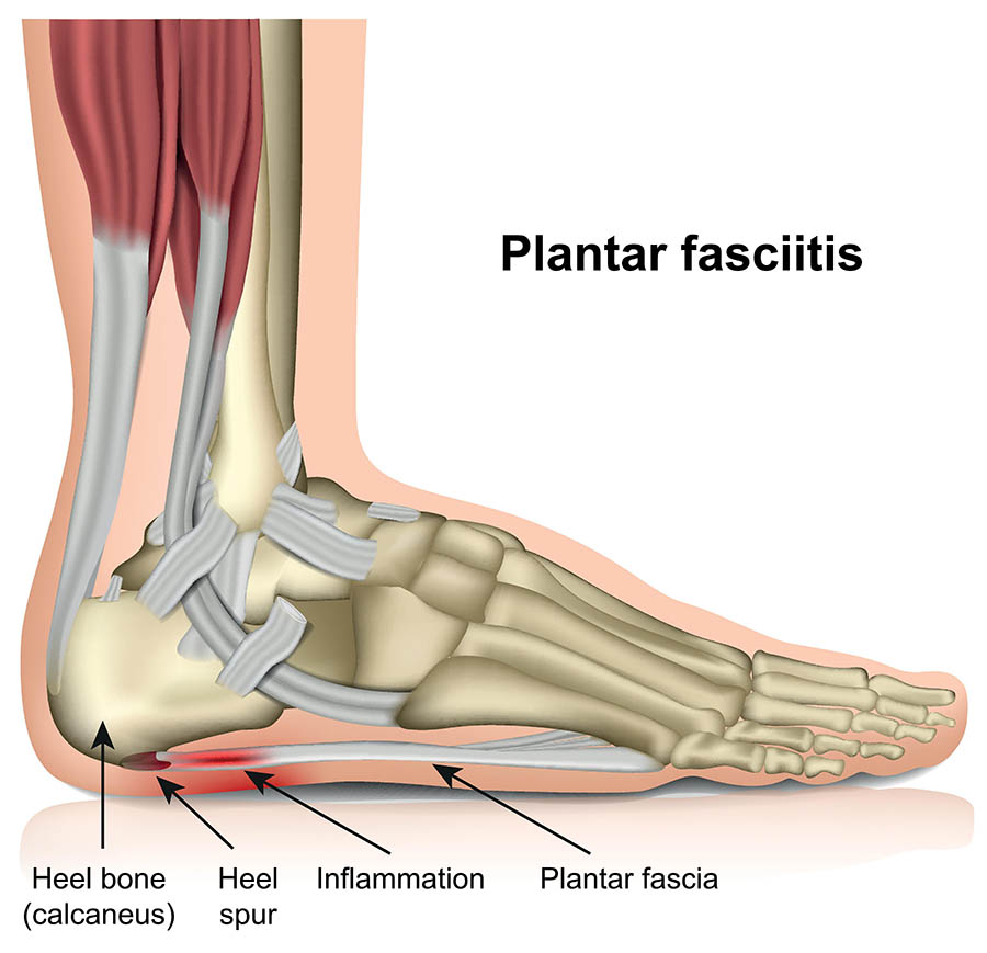 plantar fasciitis - Patella